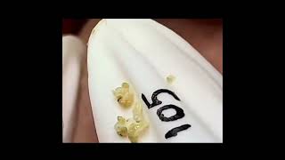 Ultimate Pimple Popping Compilation | Deep Cyst Removal & More!