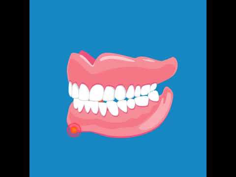 How to spot the signs of oral cancer