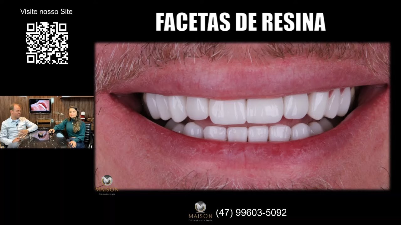 Facetas de Resina - Passo a Passo do Planejamento à Execução