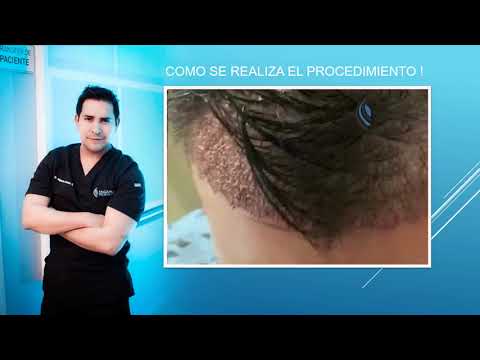 Implante de Cabello MxCapilar - Dr. Alejandro González
