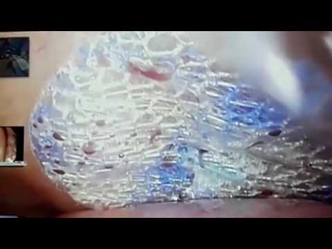 2P UCMC  Umbilical ClearMesh Composite   DIPROMED