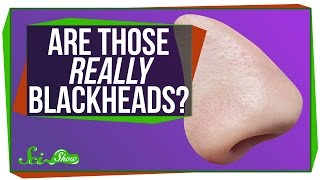 Are Those Really Blackheads?
