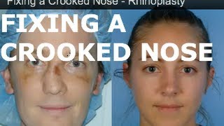 Rhinoplasty San Francisco - Fixing a Crooked Nose