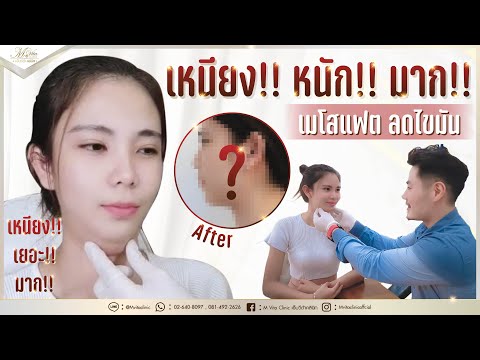 เมโสแฟต ยี่ห้อไหนดี