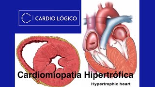Cardiomiopatia Hipertrófica