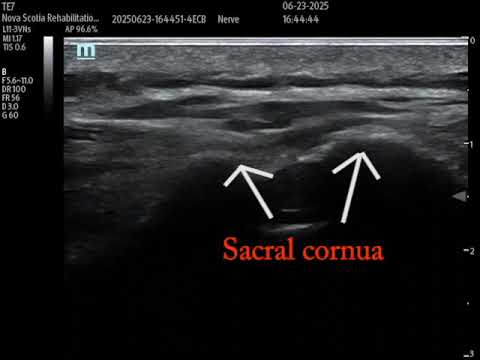 Ultrasound guided sacroiliac joint injection