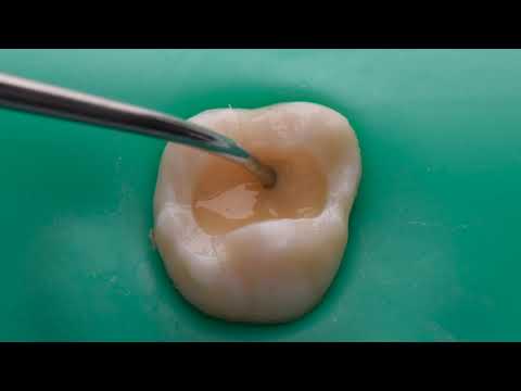 CCC   Dr  Alberto Pereira   Restauración Directa con Brilliant EverGlow   YouTube