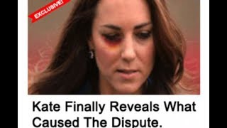 Kate Middleton ‘black-eye’ picture used in sick online advert
