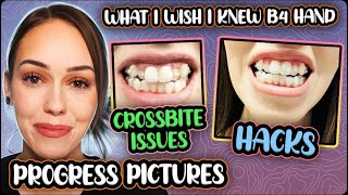 Invisalign Progress | Hacks | Do & Don'ts