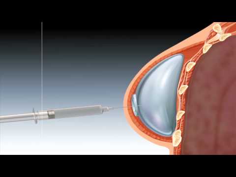Tissue Expander for Staged Breast Reconstruction