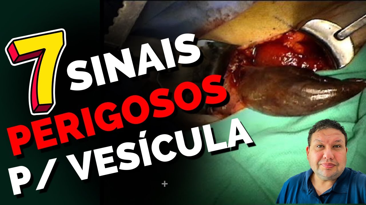 7 sinais de que sua VESÍCULA BILIAR corre perigo. Vesícula inflamada.