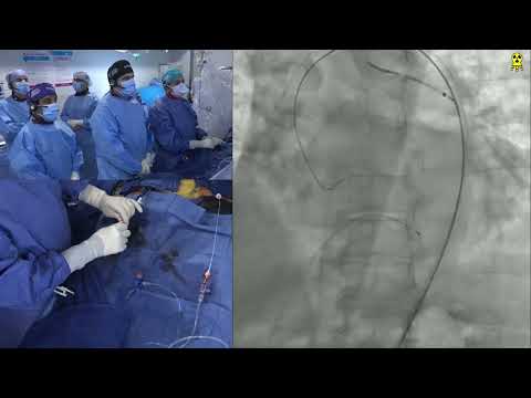 TAVR with 26mm SAPIEN 3 Ultra RESILIA with Concurrent EVAR for Abdominal Aortic Aneurysm