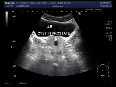 Massaggiatore Servizi della prostata BPH chirurgia harkov