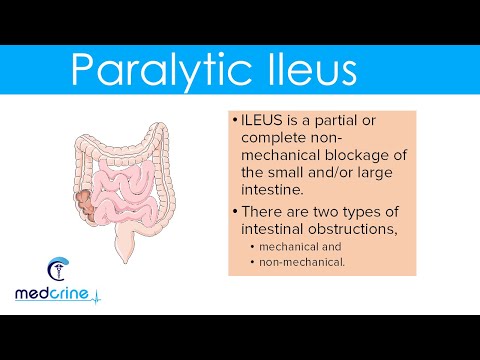 Paralytic Ileus : causes, pathophysiology, clinical features, diagnosis and treatment
