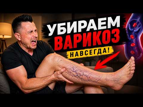ВАРИКОЗ: причины, симптомы и лечение | как работают клапаны вен, застой крови и роль коллагена