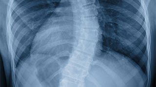 Improving Spinal Health