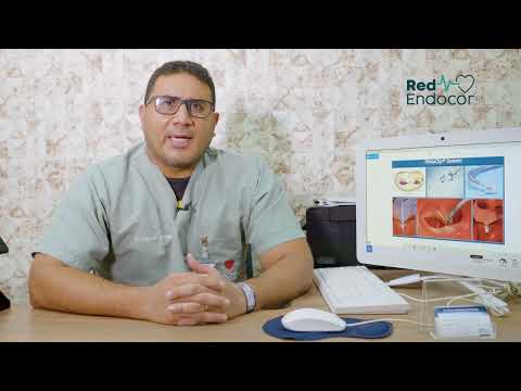 Mitraclip, tratamiento mínimamente invasivo para la Insuficiencia mitral.