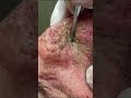 This Is One Of The Videos That Really Kicked Off This Whole Dr Pimple Popper Phenomenon