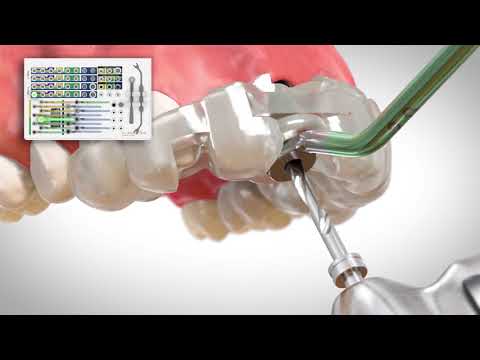 Guided Surgery from BioHorizons