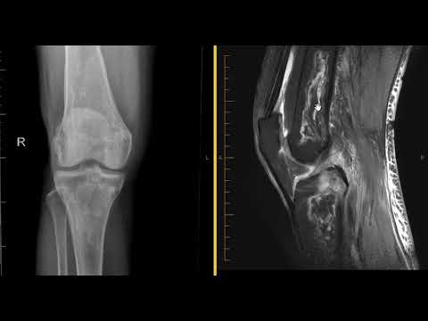 Avascular necrosis (AVN) osteonecrosis of knee