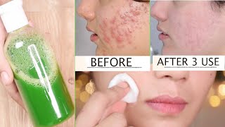 I applied this for 3 DAYS on Pus filled ACNE & PIMPLES and this is what happened- Crystal clear Skin