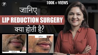 Watch video Lip Reduction Surgery | Reduce Upper and Lower Lips by Lip Surgery | Dr. Shilpi Bhadani Now Lip Reduction Surgery | Reduce Upper and Lower Lips by Lip Surgery | Dr. Shilpi Bhadani