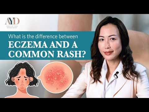 What is the difference between Eczema and a Common Rash?