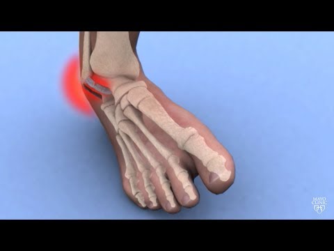 Artroza deformantă a gradului 1 al articulației genunchiului