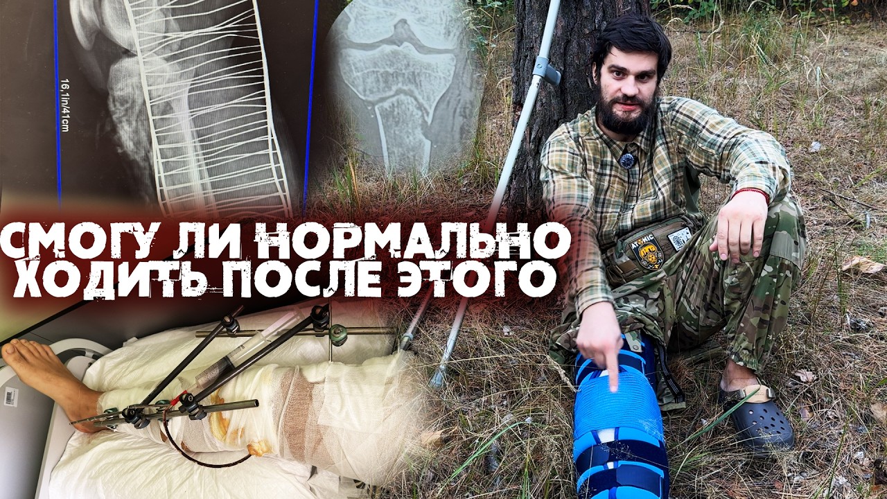 Я чуть не остался без ноги