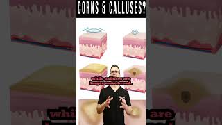 Foot CORNS & CALLUSES: How To Get Rid Of Them For Good!