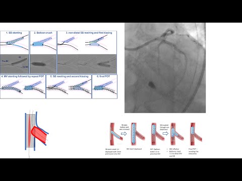Coronary bifurcation stenting part 2: two-stent techniques- Crush, DK-Crush, Culotte
