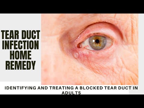 tear duct infection home remedy | Identifying and Treating a Blocked Tear Duct in Adults