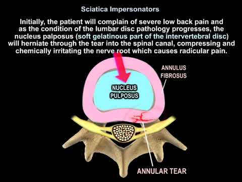 Pathologies Pouvant Mimer une Sciatique - Dr. Nabil Ebraheim