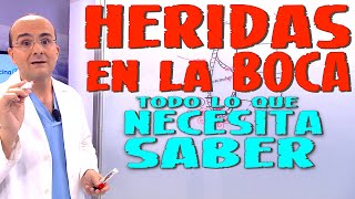 HERIDAS EN LA BOCA (AFTAS ORALES) - Todo lo que necesita saber - Enfermedades #10