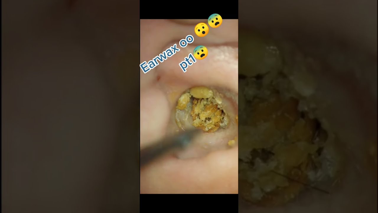 鼓膜からのきれいな肌の除去とドライクリーニング#Shorts