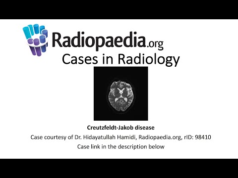 Creutzfeldt-Jakob disease (Radiopaedia.org) Cases in Radiology