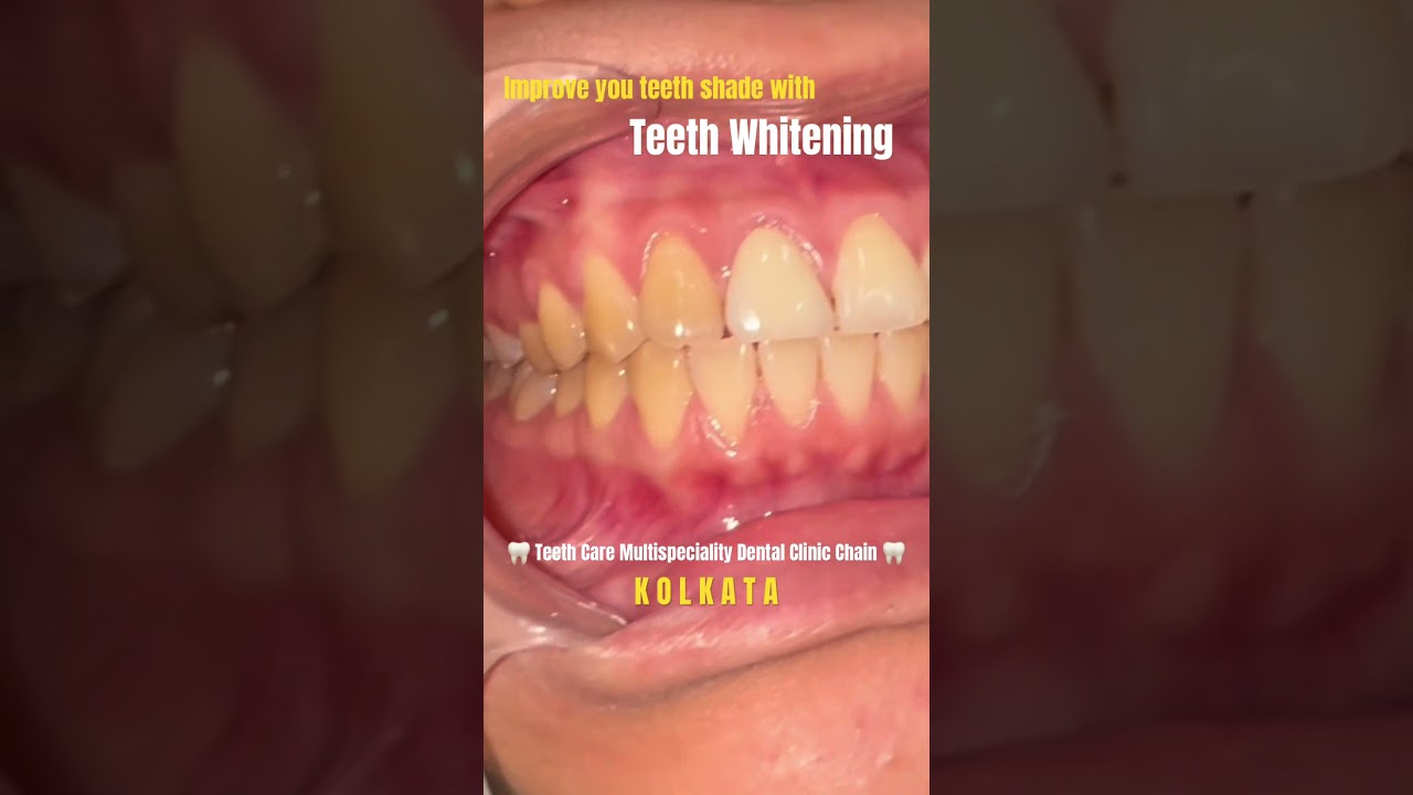 teeth whitening cost in kolkata | before after process