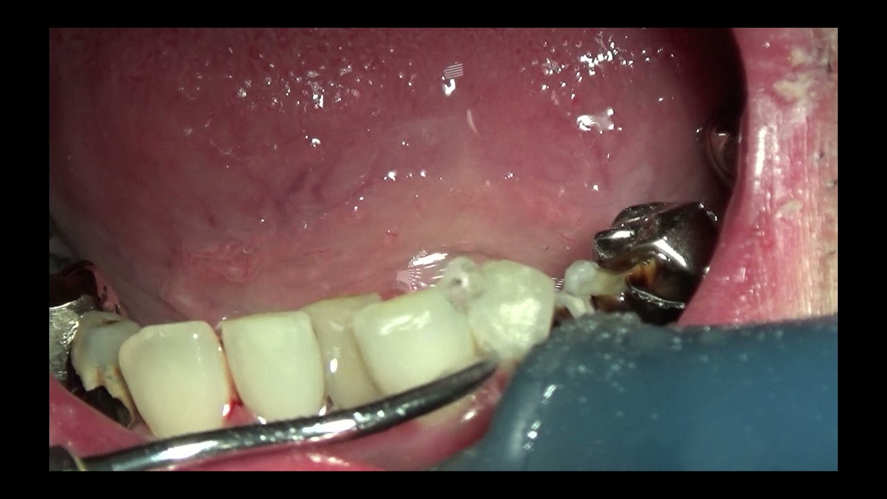 上尾の歯医者の歯周病・口臭予防の歯石取り動画 R5年10月20日 |  健康・口腔ケア