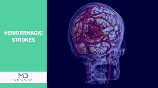 Hemorrhagic Strokes: Causes, Symptoms, and Prevention - You need to know @mdmedicine.network