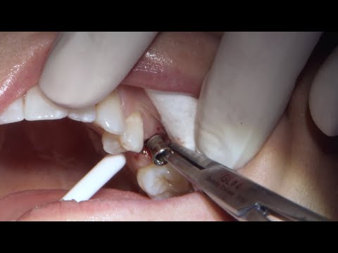  Dealing With Failed Implant Restorations