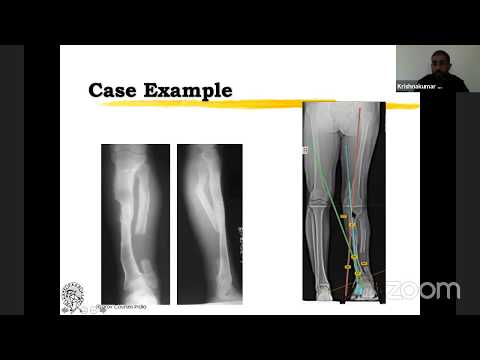 Principles of Sagittal Plane and MultiApical deformity Correction