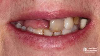 Implantes  y rehabilitación con prótesis de carga inmediata