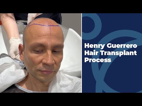 Henry Guerrero Hair Transplant Process