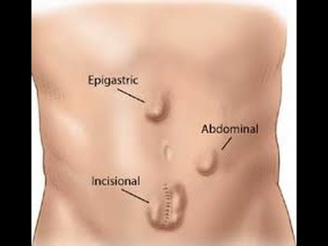 Hernia Facts and Info - YouTube