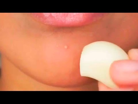 download lagu mp3 mp4 El Ajo Sirve Para El Acne, download lagu El Ajo Sirve Para El Acne gratis, unduh video klip El Ajo Sirve Para El Acne