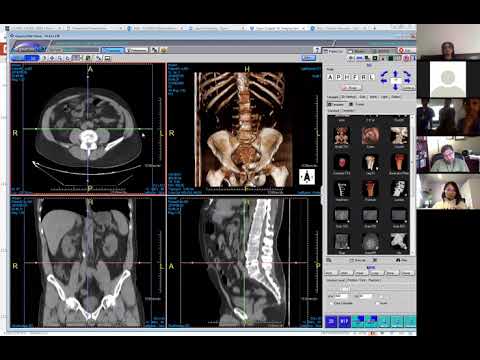 New uncinate dilated side branches - Victoria Chernyak | Pancreatic adenocarcinoma