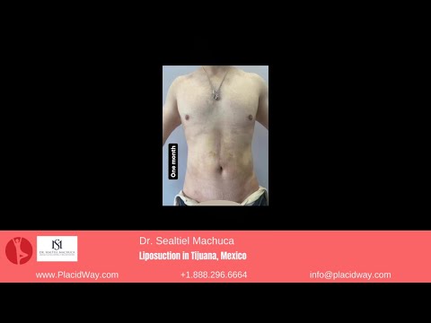 Sculpting Confidence with Liposuction by Dr. Sealtiel Machuca in Tijuana, Mexico