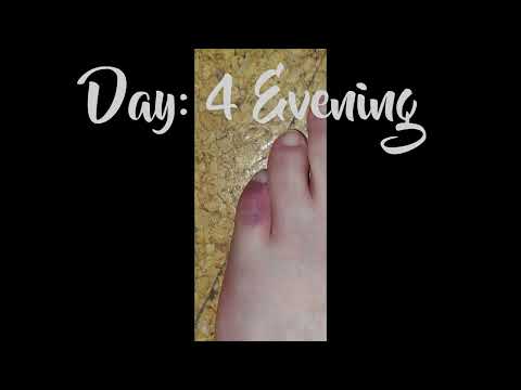 bruised toe healing timelapse