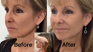 How to Get Rid of Jowls with Dermal Fillers! Step 2