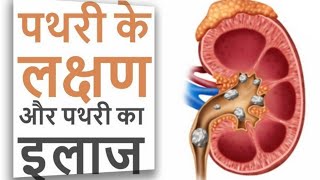 preview picture of video 'पथरी का इलाज || Kidney stone and it's treatment || Nasir Khan'